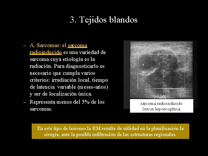 3. Tejidos blandos – A. Sarcomas: el sarcoma radioinducido es una variedad de sarcoma