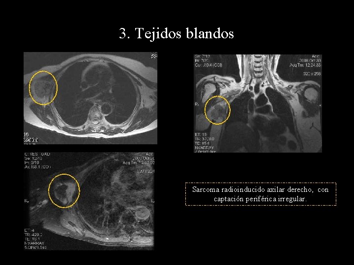 3. Tejidos blandos Sarcoma radioinducido axilar derecho, con captación periférica irregular. 