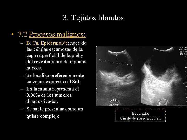 3. Tejidos blandos • 3. 2 Procesos malignos: – B. Ca. Epidermoide: nace de