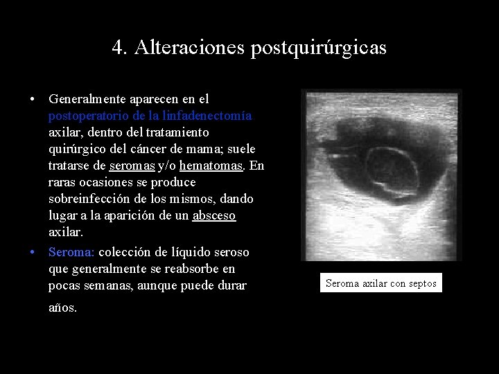 4. Alteraciones postquirúrgicas • Generalmente aparecen en el postoperatorio de la linfadenectomía axilar, dentro