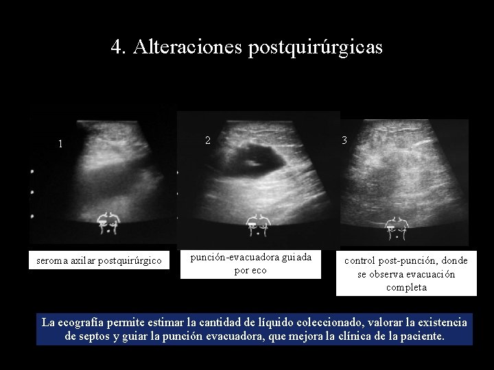 4. Alteraciones postquirúrgicas 11 seroma axilar postquirúrgico 2 2 punción-evacuadora guiada por eco 3
