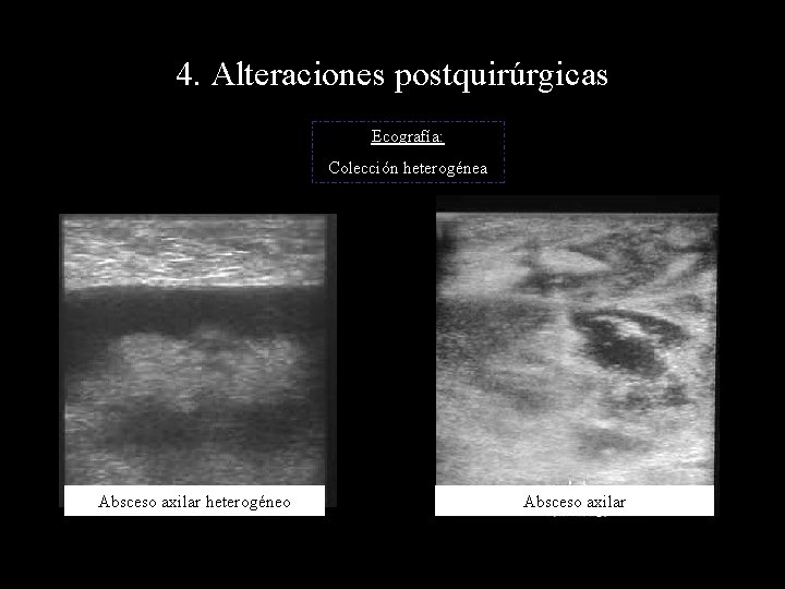 4. Alteraciones postquirúrgicas Ecografía: Colección heterogénea Absceso axilar heterogéneo Absceso axilar 