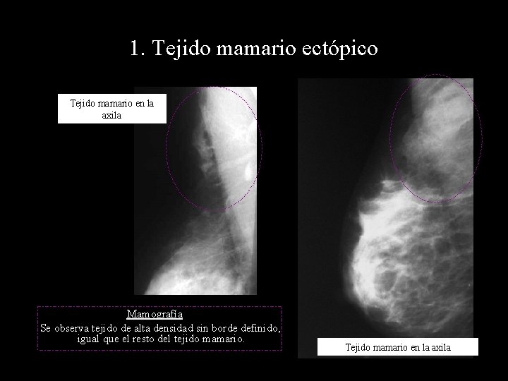 1. Tejido mamario ectópico Tejido mamario en la axila Mamografía Se observa tejido de