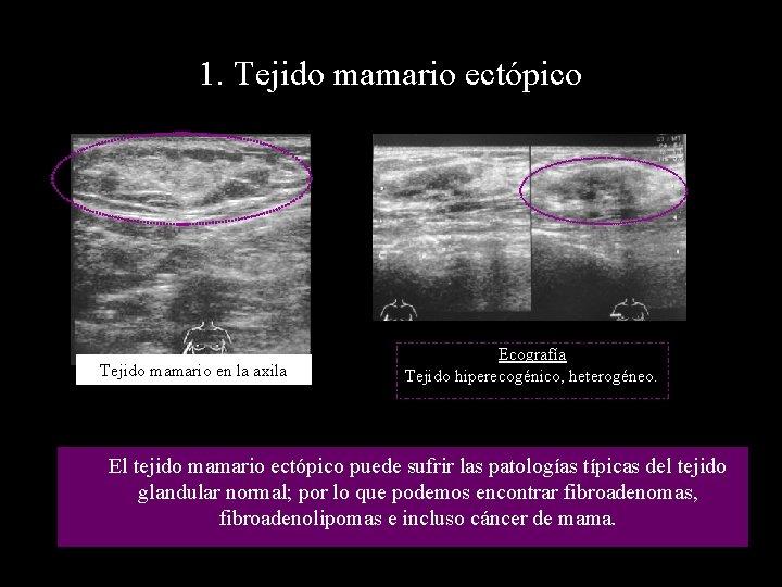 1. Tejido mamario ectópico Tejido mamario en la axila Ecografía Tejido hiperecogénico, heterogéneo. El