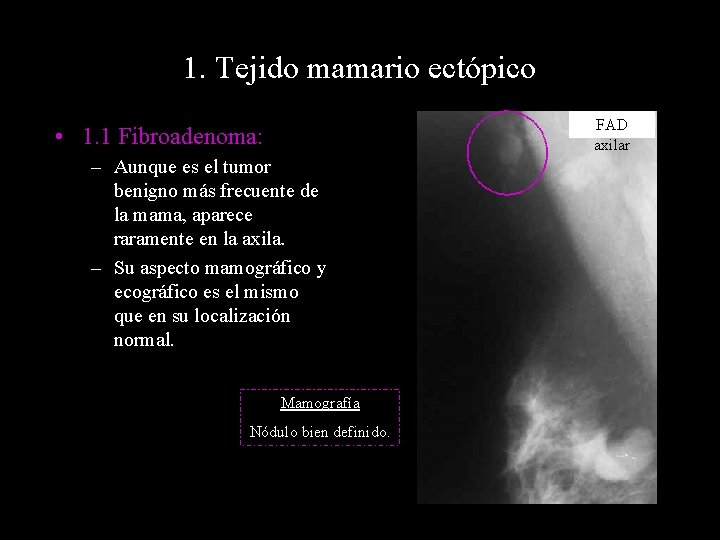 1. Tejido mamario ectópico FAD axilar • 1. 1 Fibroadenoma: – Aunque es el