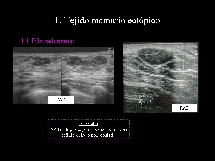 1. Tejido mamario ectópico 1. 1 Fibroadenoma: FAD axilar Ecografía Nódulo hipoecogénico de contorno