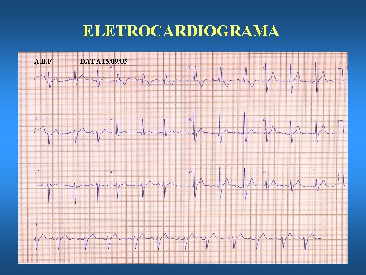 ELETROCARDIOGRAMA A. B. F DATA 15/09/05 