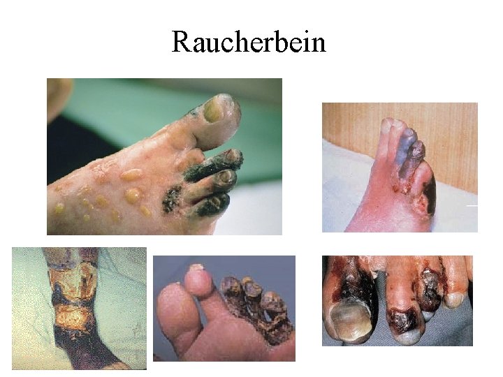 Raucherbein 