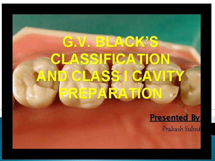 G. V. BLACK’S CLASSIFICATION AND CLASS I CAVITY PREPARATION Presented By: Prakash Subedi 