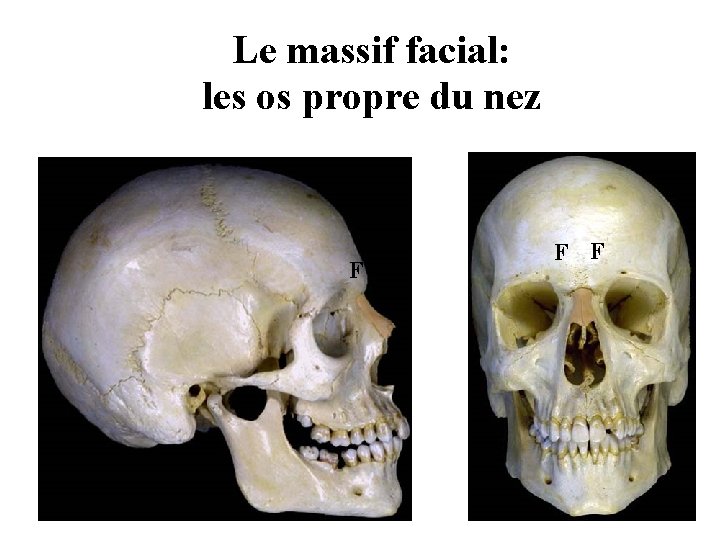 Le massif facial: les os propre du nez F F F Le massif facial: les os propre du nez F F F
