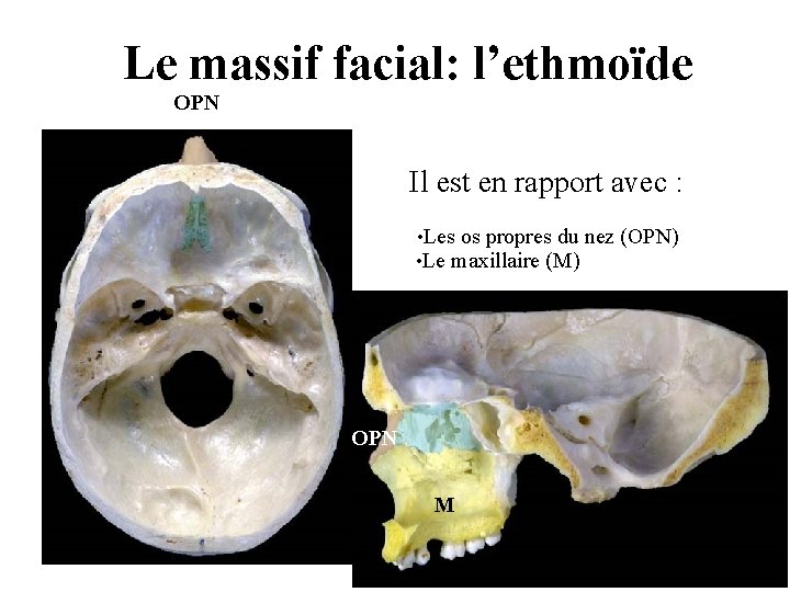 Le massif facial: l’ethmoïde OPN Il est en rapport avec : • Les os Le massif facial: l’ethmoïde OPN Il est en rapport avec : • Les os