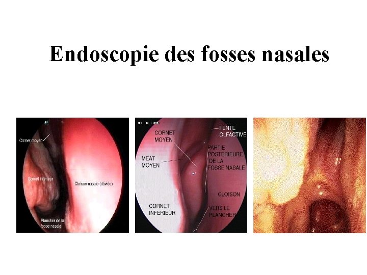 Endoscopie des fosses nasales Endoscopie des fosses nasales