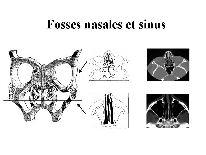 Fosses nasales et sinus Fosses nasales et sinus