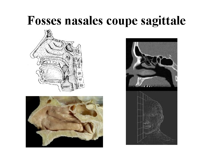 Fosses nasales coupe sagittale Fosses nasales coupe sagittale