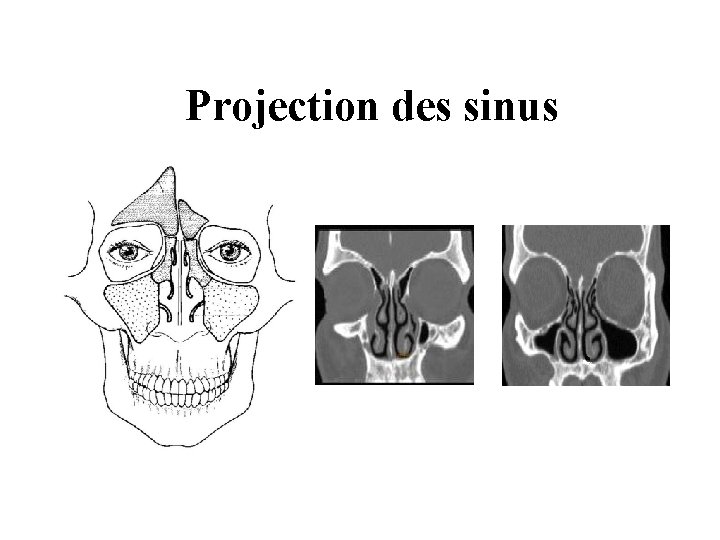 Projection des sinus Projection des sinus