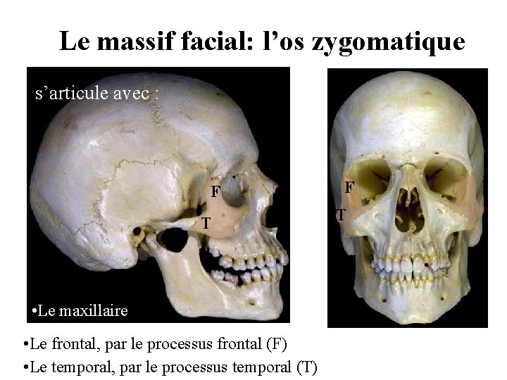 Le massif facial: l’os zygomatique s’articule avec : F T • Le maxillaire • Le massif facial: l’os zygomatique s’articule avec : F T • Le maxillaire •