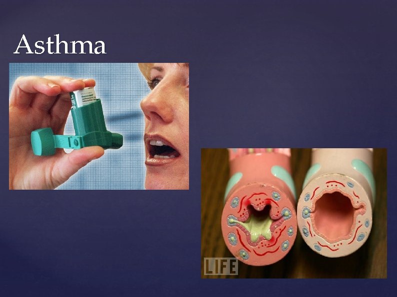 Asthma Asthma