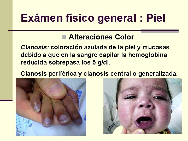 Exámen físico general : Piel n Alteraciones Color Cianosis: coloración azulada de la piel