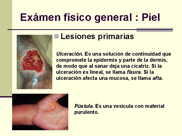 Exámen físico general : Piel n Lesiones primarias Ulceración. Es una solución de continuidad