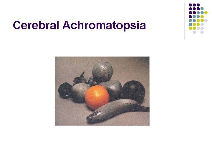 Cerebral Achromatopsia 