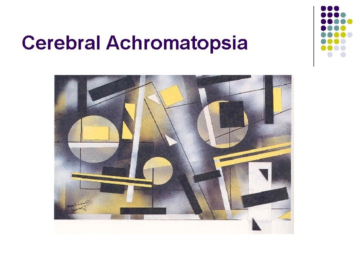 Cerebral Achromatopsia 