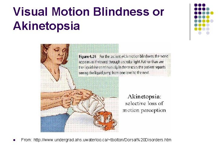 Visual Motion Blindness or Akinetopsia l From: http: //www. undergrad. ahs. uwaterloo. ca/~tbolton/Dorsal%20 Disorders.