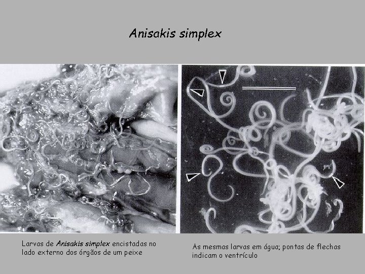 Anisakis simplex Larvas de Anisakis simplex encistadas no lado externo dos órgãos de um Anisakis simplex Larvas de Anisakis simplex encistadas no lado externo dos órgãos de um