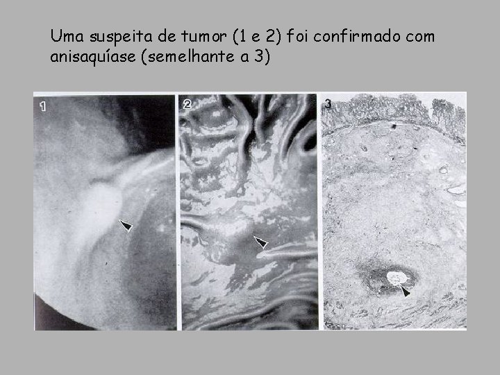 Uma suspeita de tumor (1 e 2) foi confirmado com anisaquíase (semelhante a 3) Uma suspeita de tumor (1 e 2) foi confirmado com anisaquíase (semelhante a 3)
