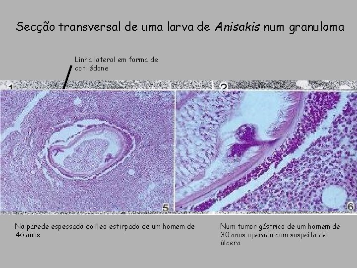 Secção transversal de uma larva de Anisakis num granuloma Linha lateral em forma de Secção transversal de uma larva de Anisakis num granuloma Linha lateral em forma de