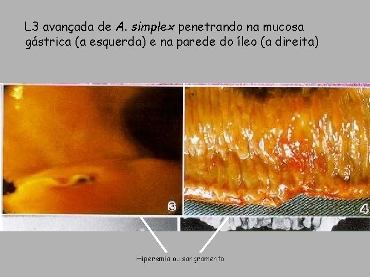 L 3 avançada de A. simplex penetrando na mucosa gástrica (a esquerda) e na L 3 avançada de A. simplex penetrando na mucosa gástrica (a esquerda) e na