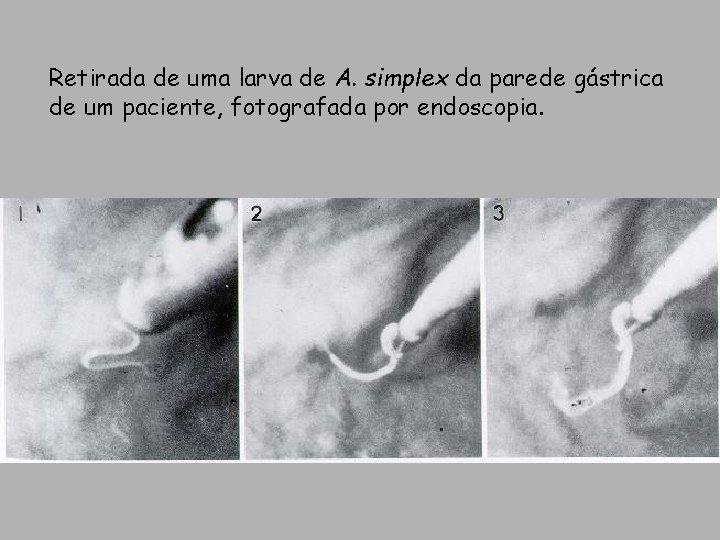 Retirada de uma larva de A. simplex da parede gástrica de um paciente, fotografada Retirada de uma larva de A. simplex da parede gástrica de um paciente, fotografada