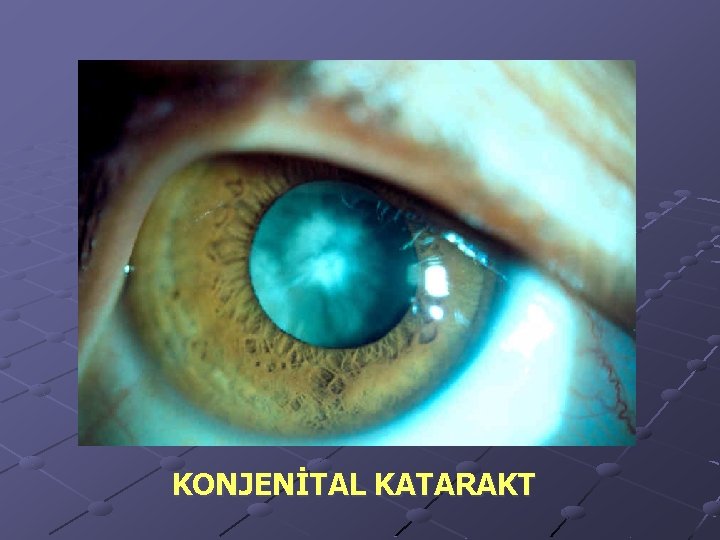 KONJENİTAL KATARAKT 
