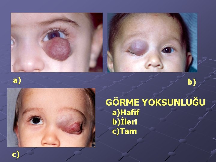 a) b) GÖRME YOKSUNLUĞU a)Hafif b)İleri c)Tam c) 