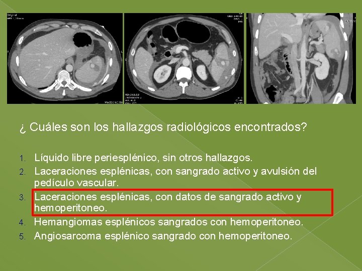 ¿ Cuáles son los hallazgos radiológicos encontrados? 1. 2. 3. 4. 5. Líquido libre