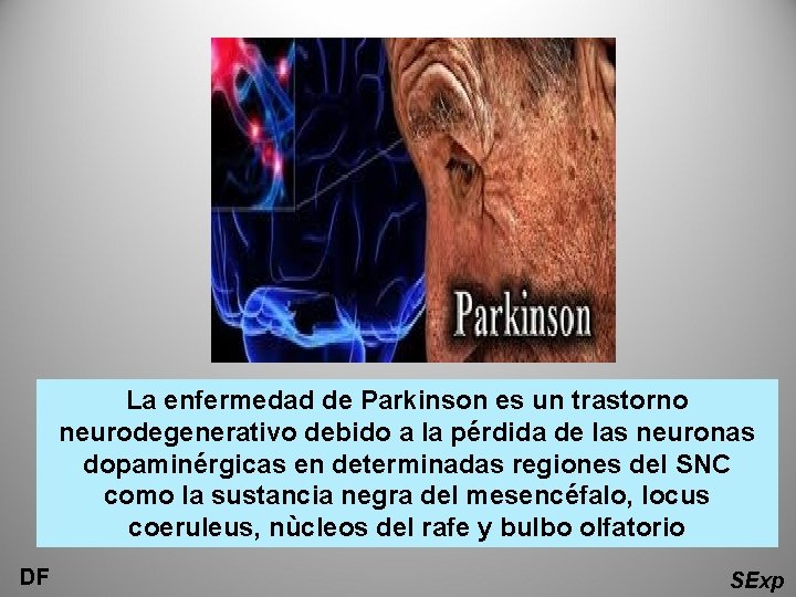 La enfermedad de Parkinson es un trastorno neurodegenerativo debido a la pérdida de las