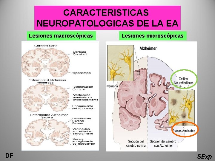 CARACTERISTICAS NEUROPATOLOGICAS DE LA EA Lesiones macroscópicas DF Lesiones microscópicas SExp CARACTERISTICAS NEUROPATOLOGICAS DE LA EA Lesiones macroscópicas DF Lesiones microscópicas SExp