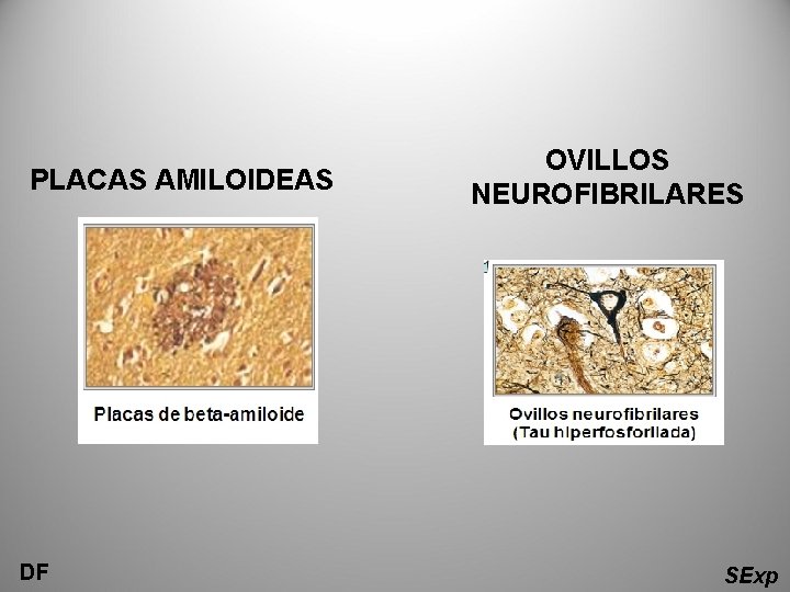 PLACAS AMILOIDEAS DF OVILLOS NEUROFIBRILARES SExp 