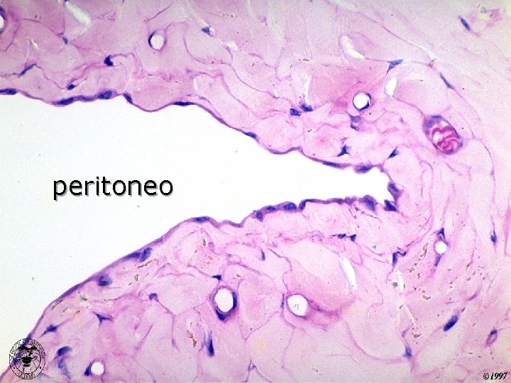 peritoneo 