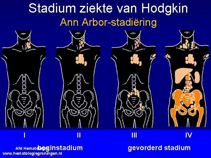 Stadium ziekte van Hodgkin Ann Arbor-stadiëring I II beginstadium Afd Hematologie; www. hematologiegroningen. nl