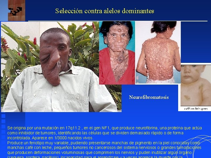 Selección contra alelos dominantes Neurofibromatosis Se origina por una mutación en 17 q 11.