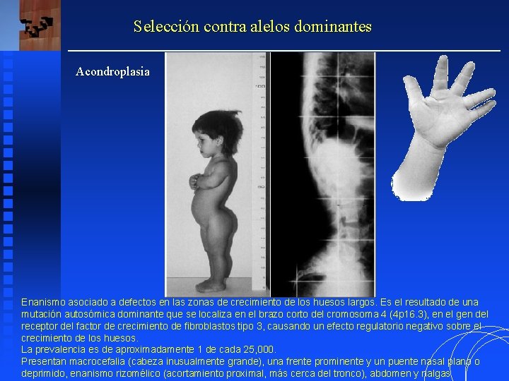 Selección contra alelos dominantes Acondroplasia Enanismo asociado a defectos en las zonas de crecimiento