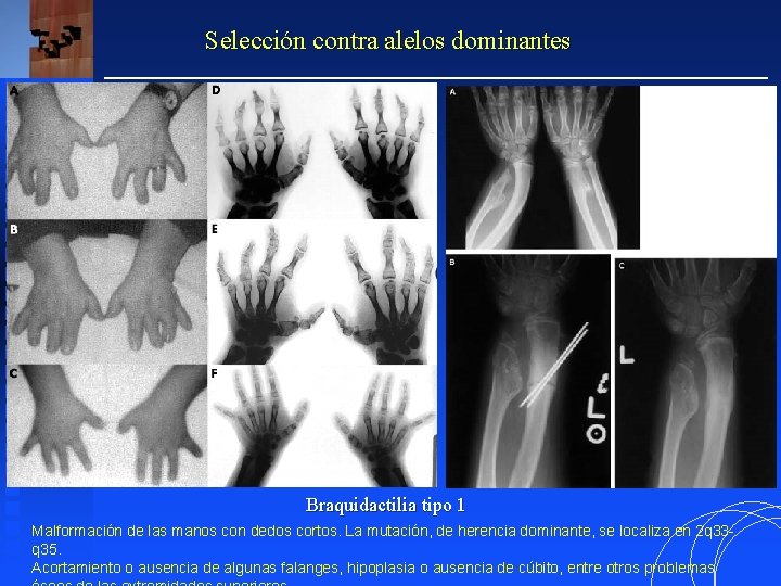 Selección contra alelos dominantes Braquidactilia tipo 1 Malformación de las manos con dedos cortos.