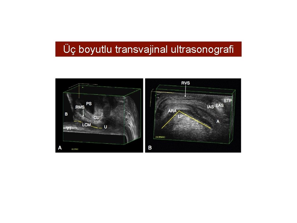 Üç boyutlu transvajinal ultrasonografi 