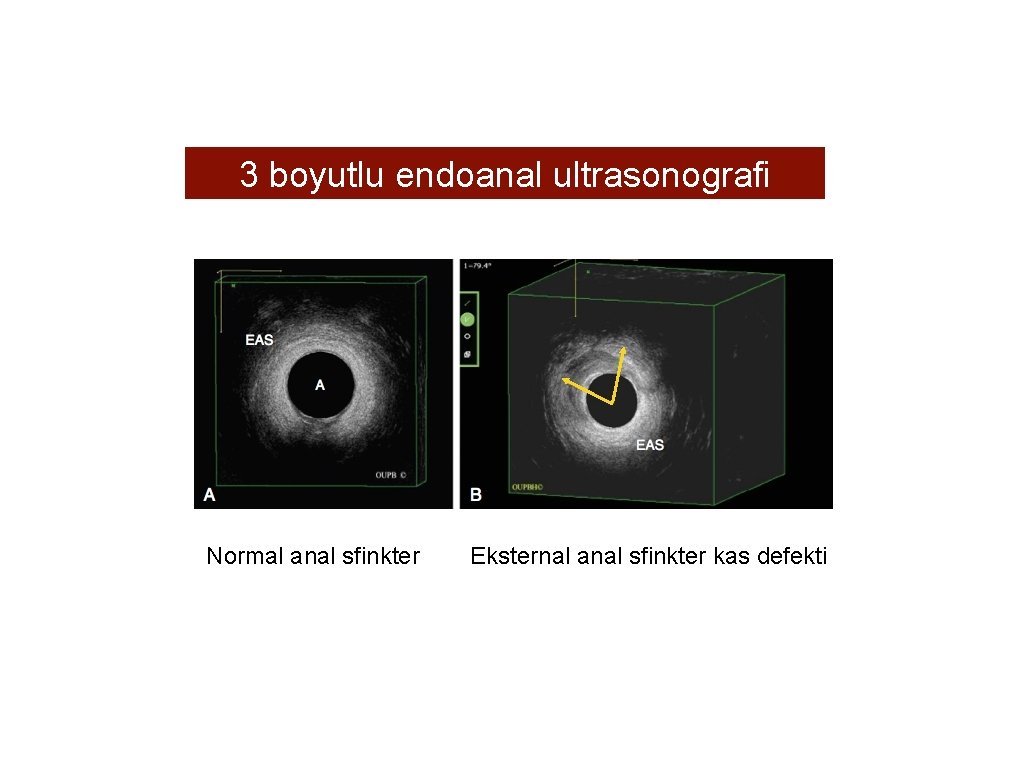 3 boyutlu endoanal ultrasonografi Normal anal sfinkter Eksternal anal sfinkter kas defekti 