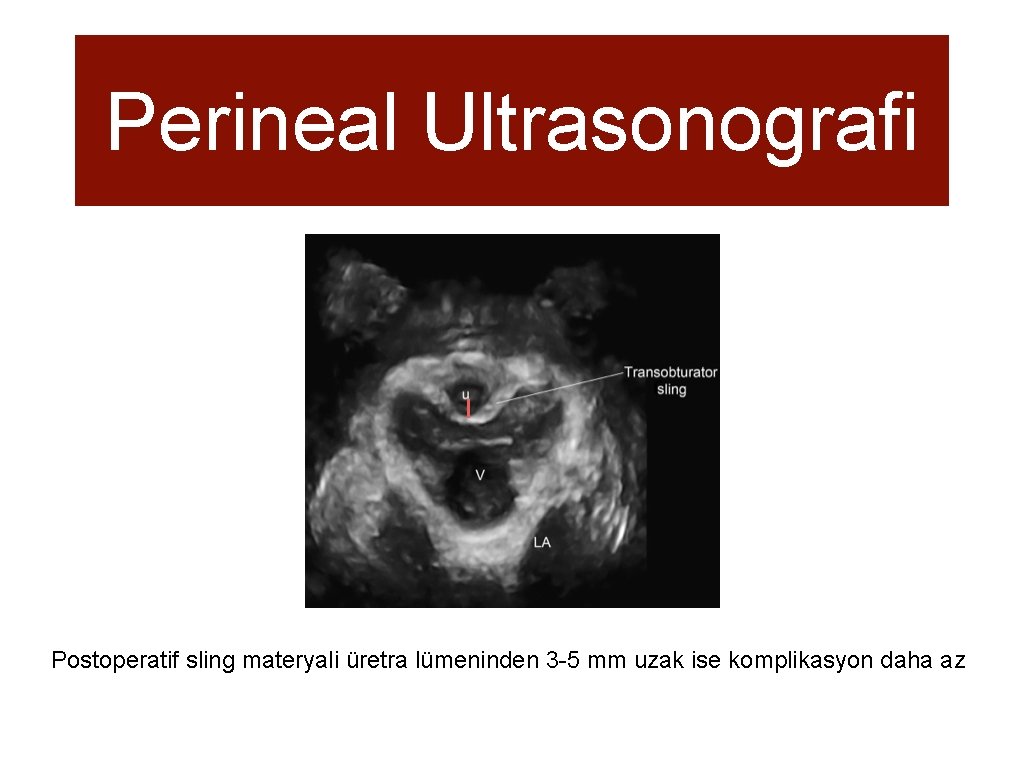 Perineal Ultrasonografi Postoperatif sling materyali üretra lümeninden 3 -5 mm uzak ise komplikasyon daha