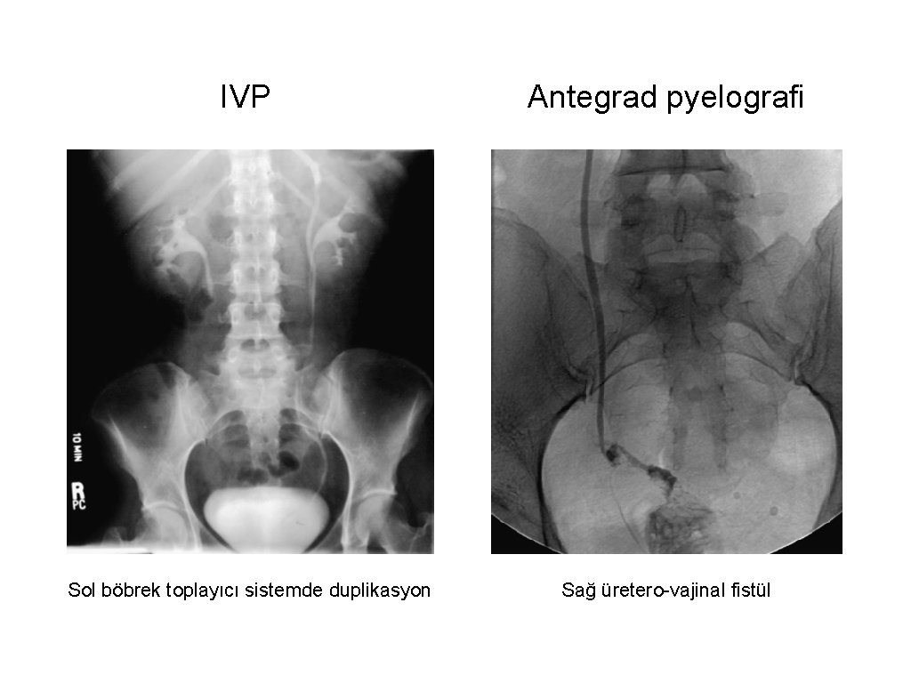IVP Antegrad pyelografi Sol böbrek toplayıcı sistemde duplikasyon Sağ üretero-vajinal fistül 