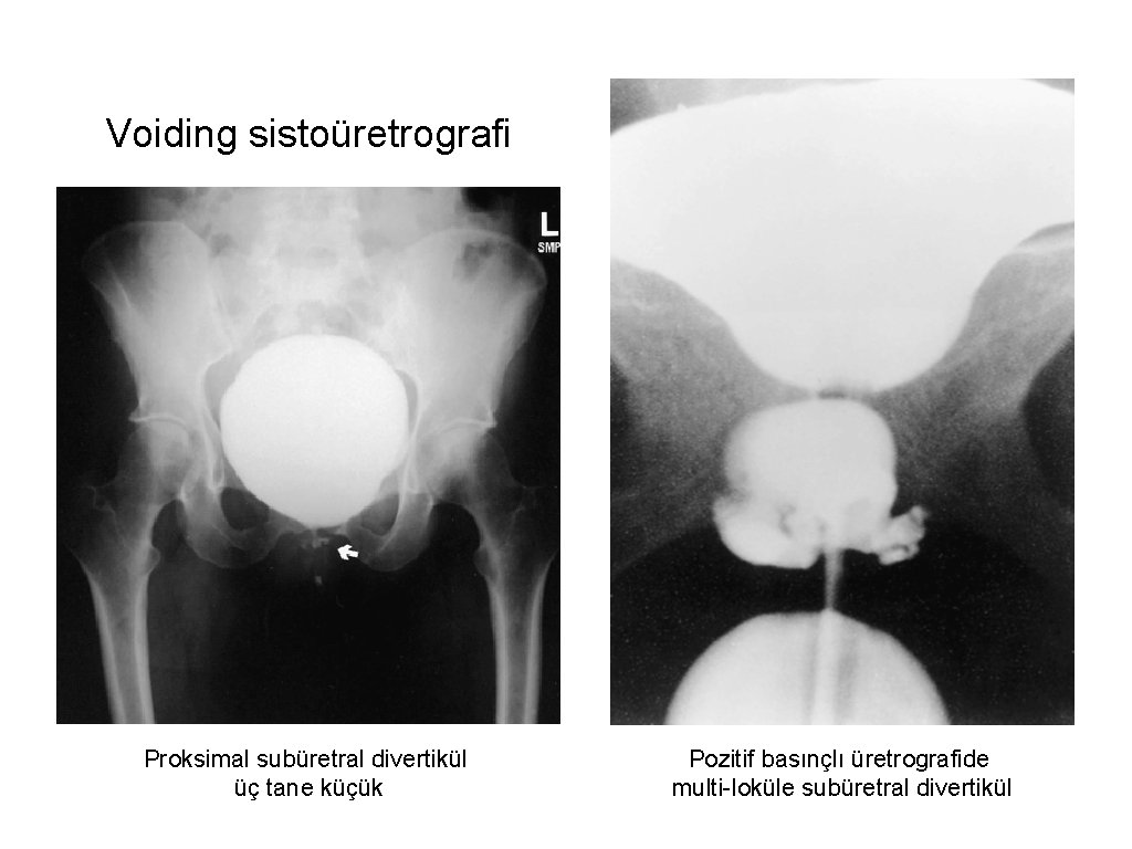 Voiding sistoüretrografi Proksimal subüretral divertikül üç tane küçük Pozitif basınçlı üretrografide multi-loküle subüretral divertikül