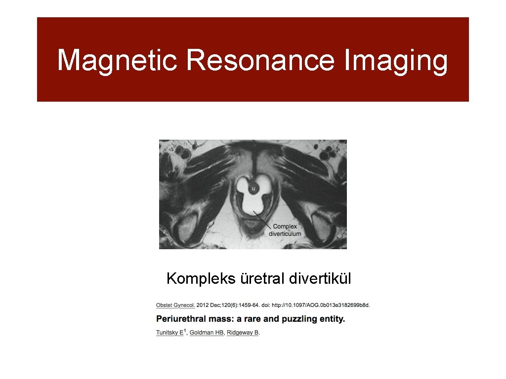 Magnetic Resonance Imaging Kompleks üretral divertikül 