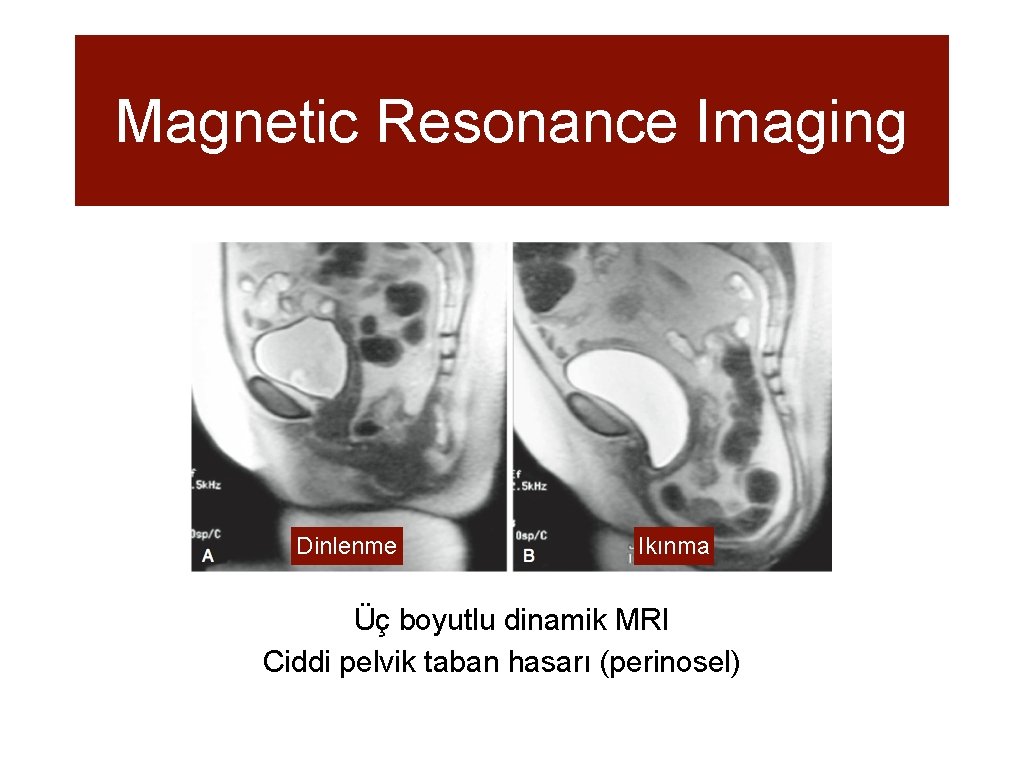 Magnetic Resonance Imaging Dinlenme Ikınma Üç boyutlu dinamik MRI Ciddi pelvik taban hasarı (perinosel)