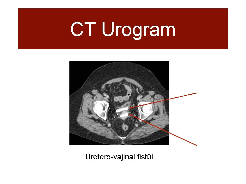 CT Urogram Üretero-vajinal fistül 